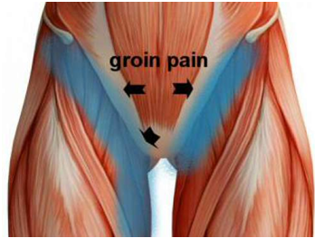 What Is Your Groin Pain Rhp Physiotherapy